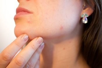I rimedi contro l’acne
